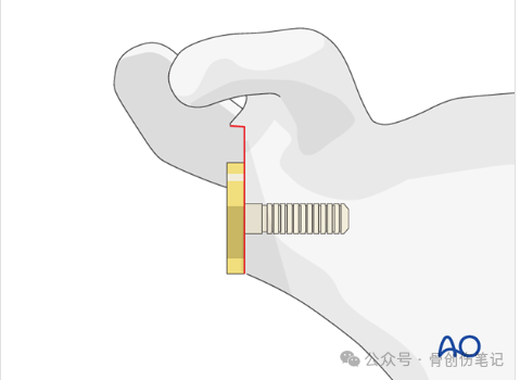 AO反肩关节置换术全流程拆解（附高清操作图解）