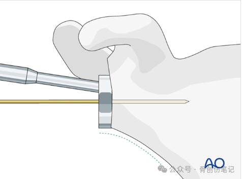 AO反肩关节置换术全流程拆解（附高清操作图解）