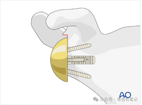 AO反肩关节置换术全流程拆解（附高清操作图解）