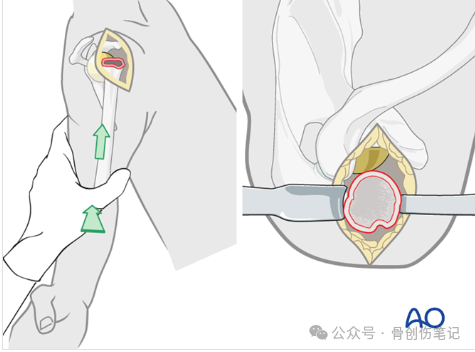 AO反肩关节置换术全流程拆解（附高清操作图解）