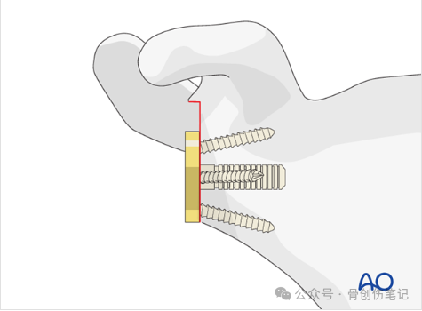 AO反肩关节置换术全流程拆解（附高清操作图解）