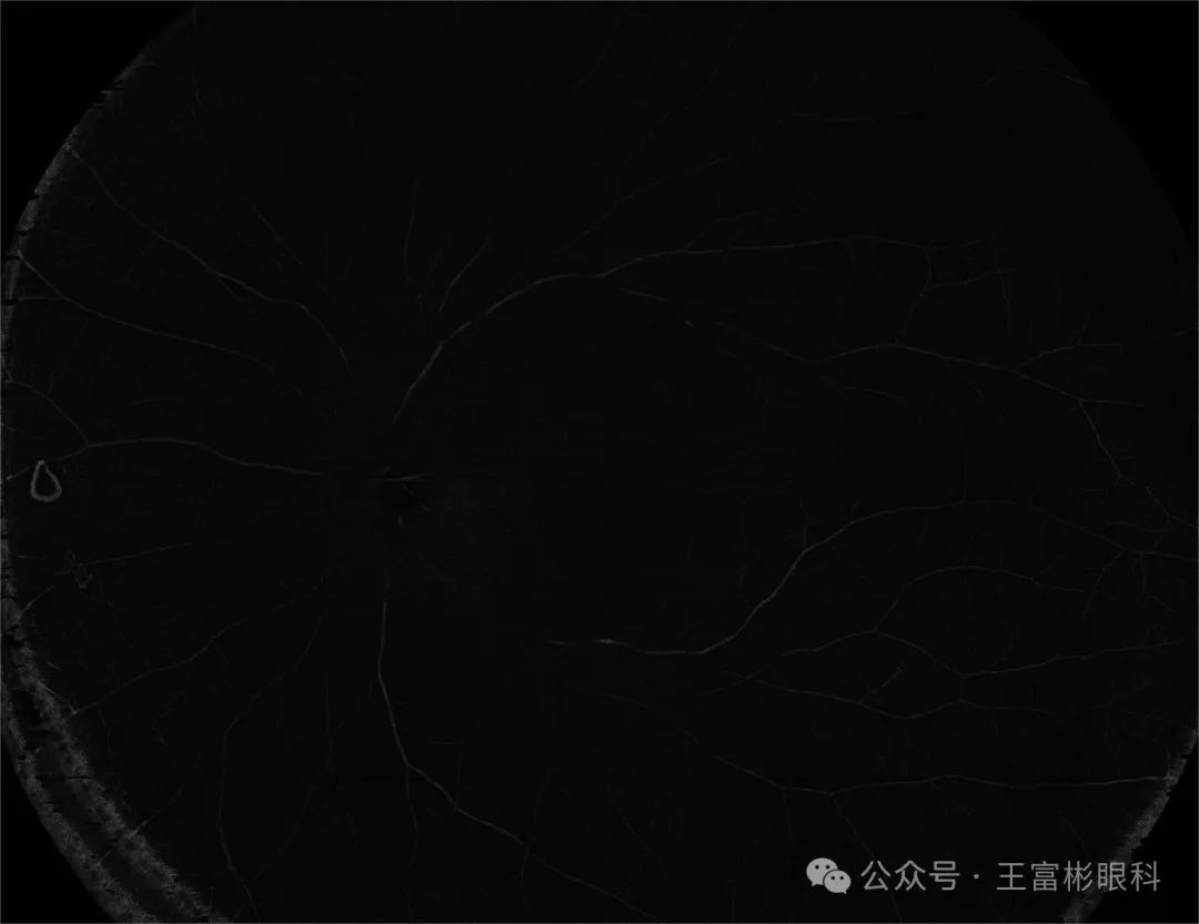 糖尿病视网膜病变的血管袢OCT影像表达