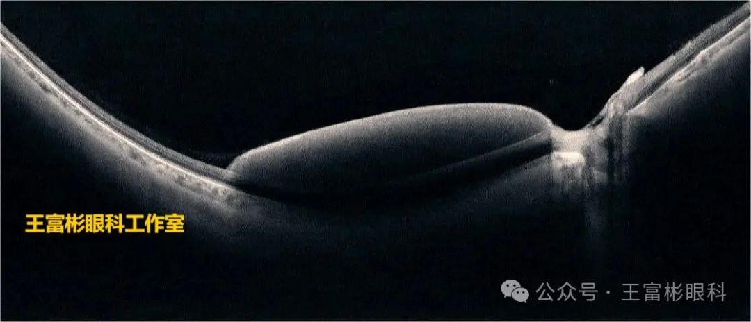 糖尿病视网膜病变的血管袢OCT影像表达