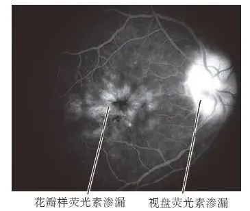 黄斑水肿≠玻璃体腔注药
