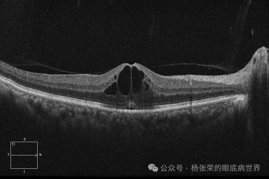 黄斑水肿≠玻璃体腔注药