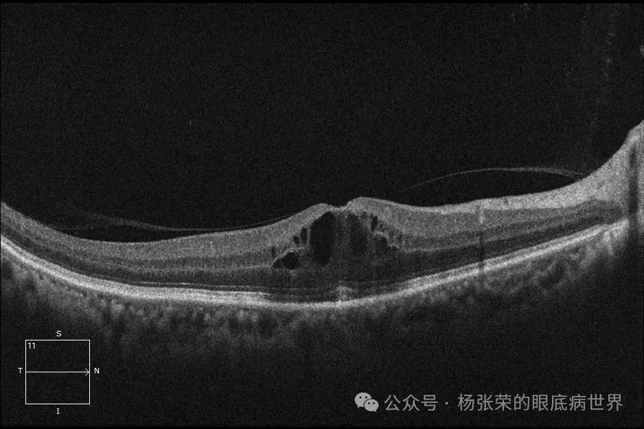 黄斑水肿≠玻璃体腔注药