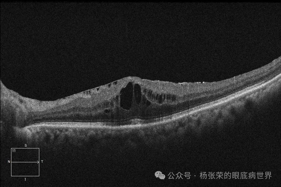 黄斑水肿≠玻璃体腔注药
