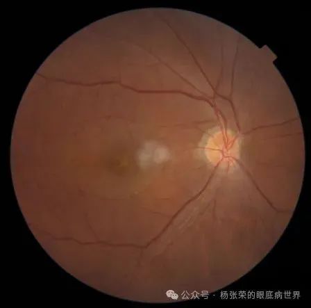 黄斑水肿≠玻璃体腔注药