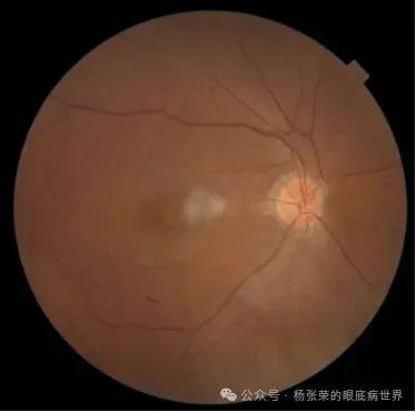 黄斑水肿≠玻璃体腔注药