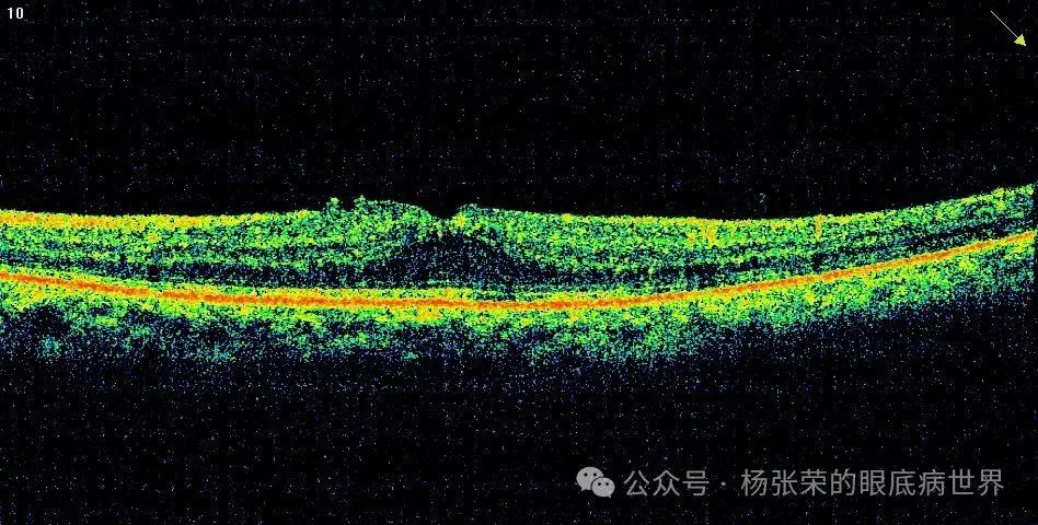 黄斑水肿≠玻璃体腔注药