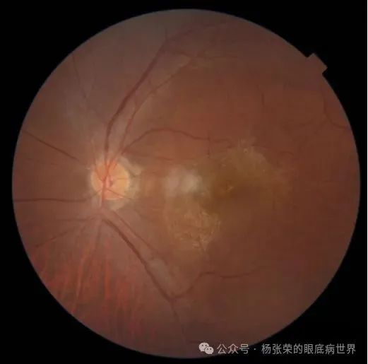 黄斑水肿≠玻璃体腔注药