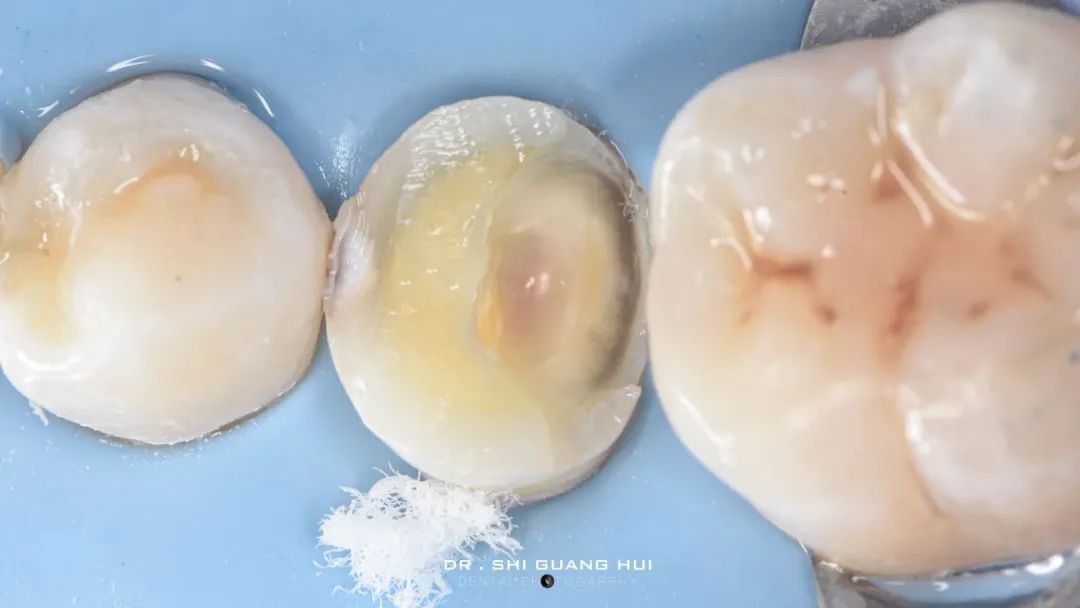 龈下缺损的新分类及治疗指南（前磨牙RCT龈壁提升后全覆盖嵌体修复一例）