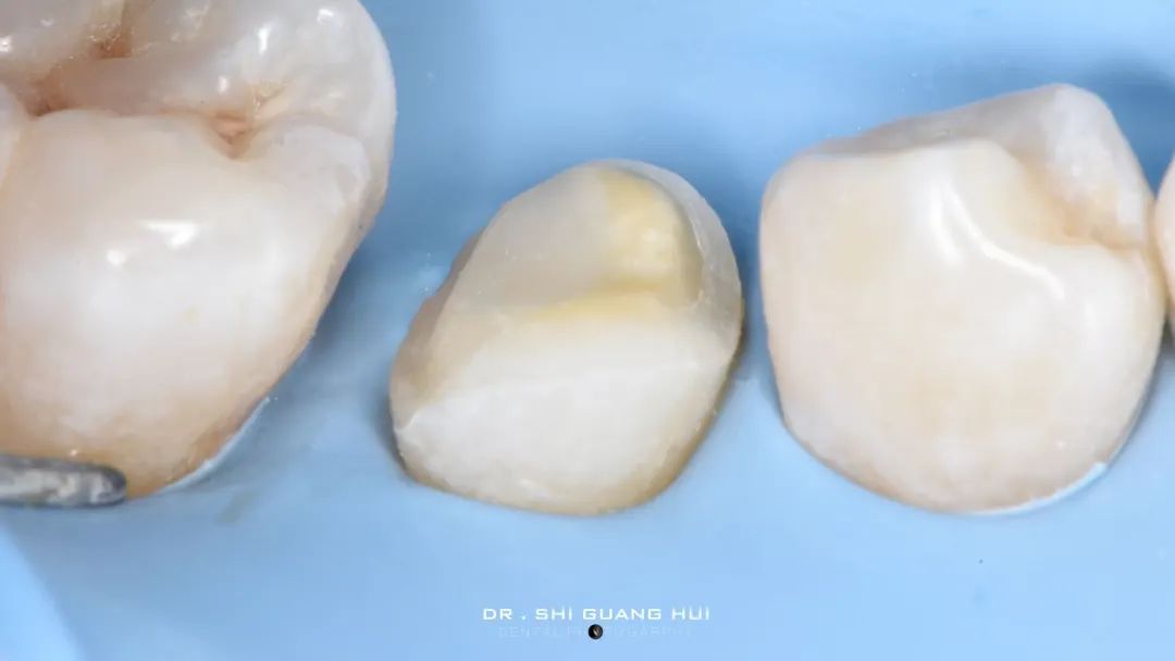 龈下缺损的新分类及治疗指南（前磨牙RCT龈壁提升后全覆盖嵌体修复一例）