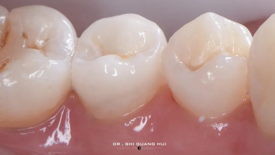 龈下缺损的新分类及治疗指南（前磨牙RCT龈壁提升后全覆盖嵌体修复一例）