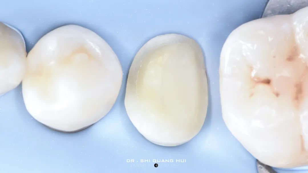 龈下缺损的新分类及治疗指南（前磨牙RCT龈壁提升后全覆盖嵌体修复一例）