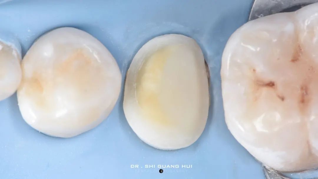 龈下缺损的新分类及治疗指南（前磨牙RCT龈壁提升后全覆盖嵌体修复一例）