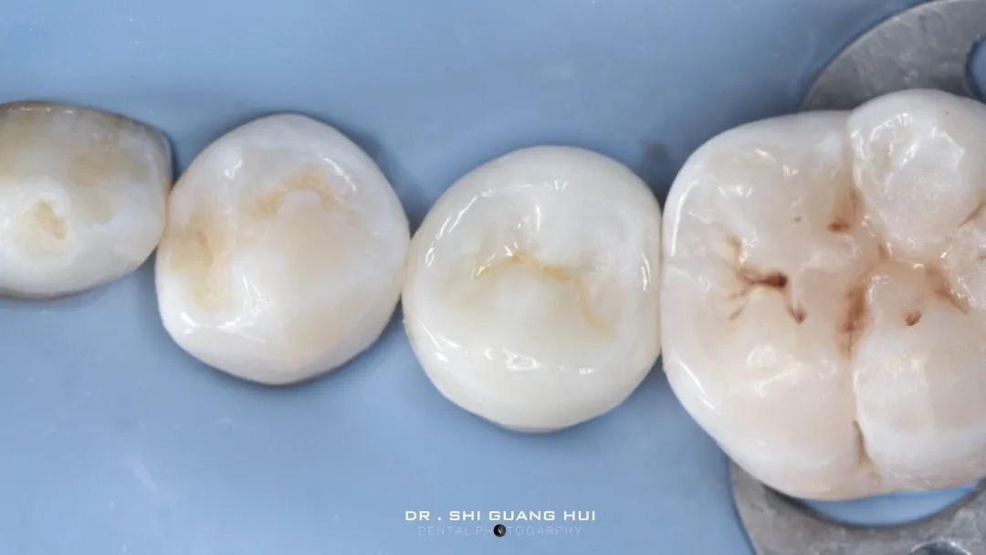 龈下缺损的新分类及治疗指南（前磨牙RCT龈壁提升后全覆盖嵌体修复一例）