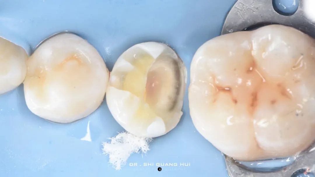 龈下缺损的新分类及治疗指南（前磨牙RCT龈壁提升后全覆盖嵌体修复一例）