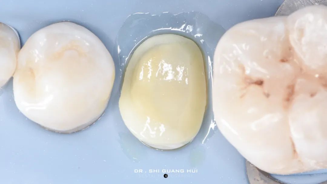 龈下缺损的新分类及治疗指南（前磨牙RCT龈壁提升后全覆盖嵌体修复一例）