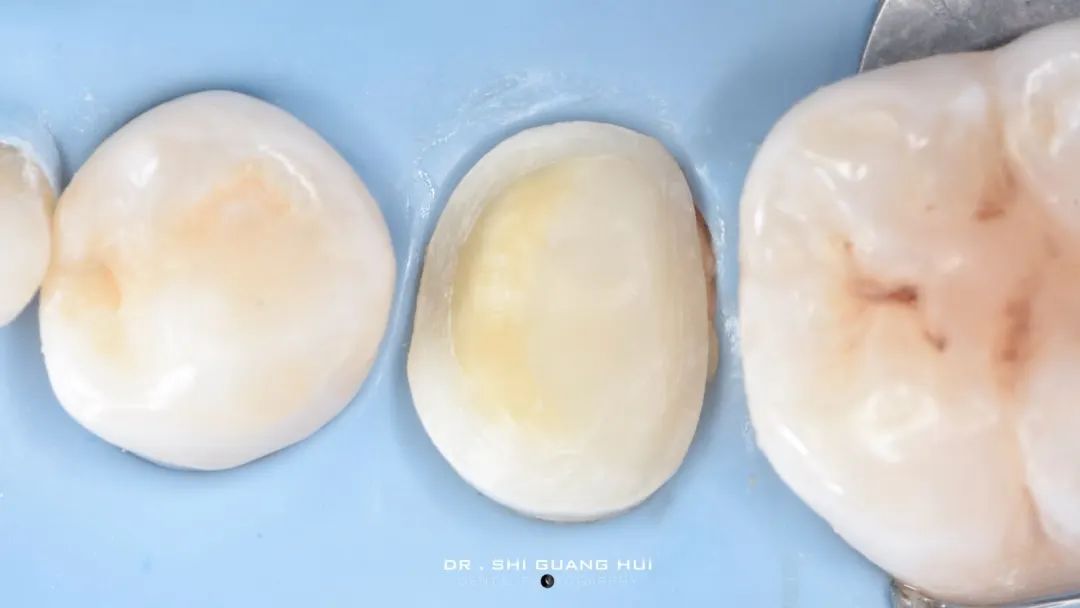 龈下缺损的新分类及治疗指南（前磨牙RCT龈壁提升后全覆盖嵌体修复一例）