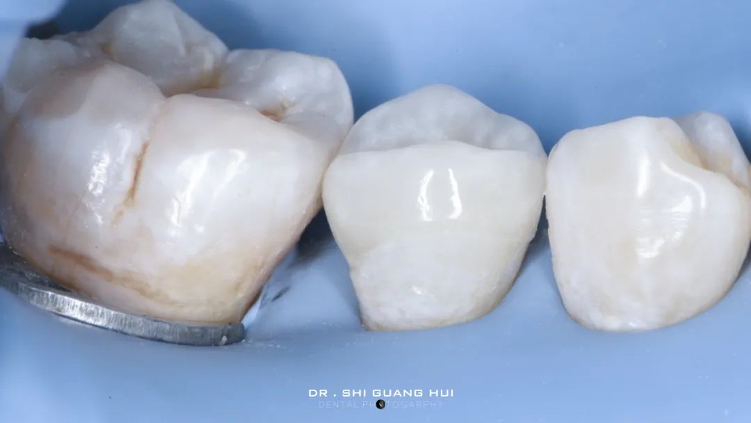 龈下缺损的新分类及治疗指南（前磨牙RCT龈壁提升后全覆盖嵌体修复一例）
