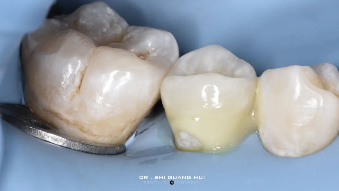 龈下缺损的新分类及治疗指南（前磨牙RCT龈壁提升后全覆盖嵌体修复一例）