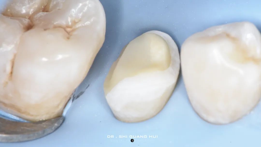 龈下缺损的新分类及治疗指南（前磨牙RCT龈壁提升后全覆盖嵌体修复一例）