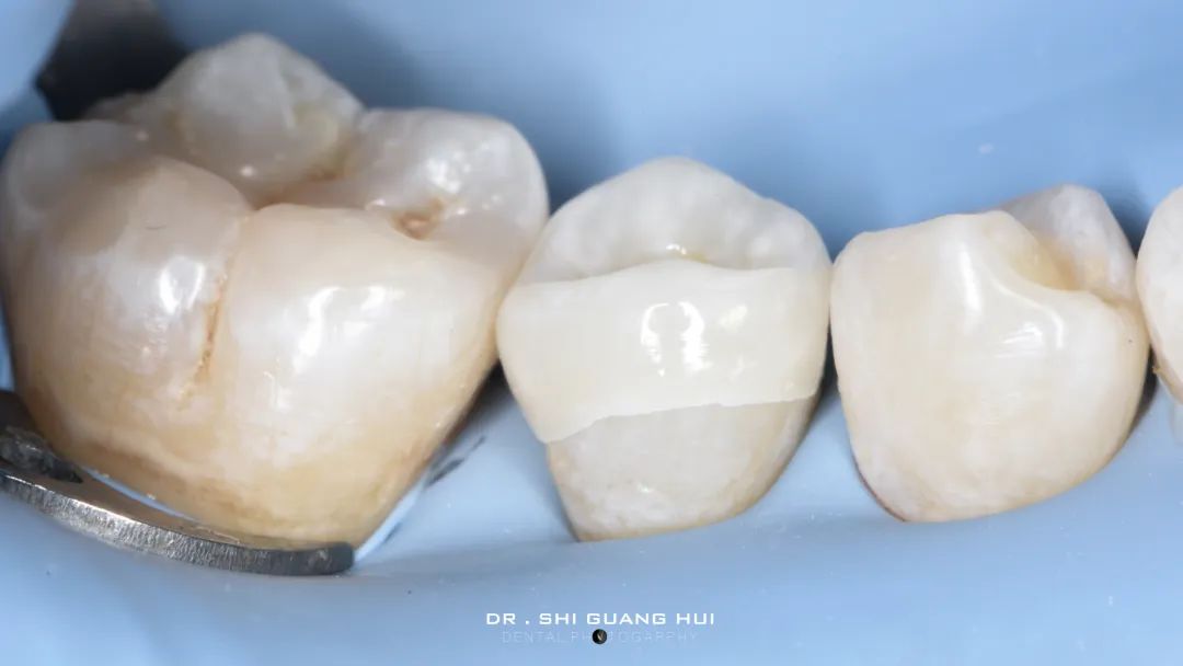 龈下缺损的新分类及治疗指南（前磨牙RCT龈壁提升后全覆盖嵌体修复一例）