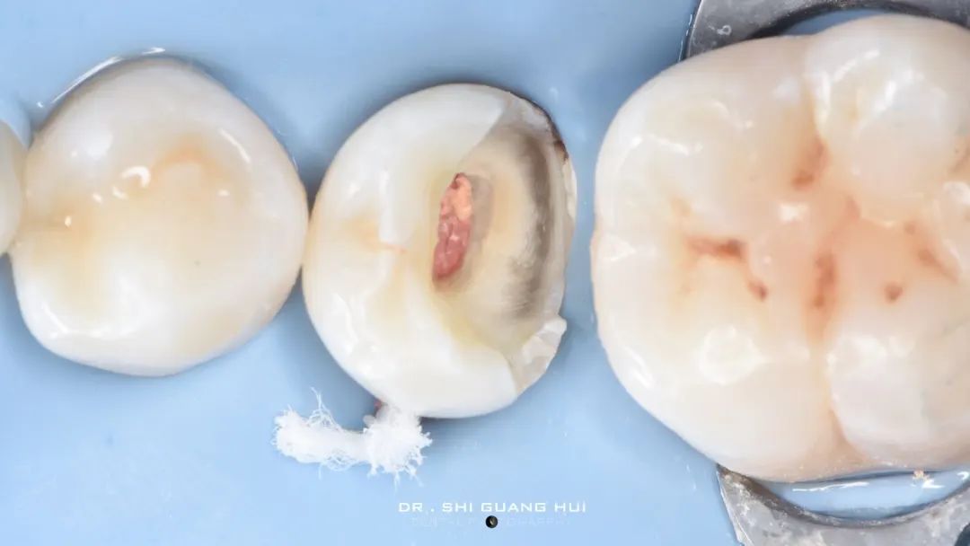 龈下缺损的新分类及治疗指南（前磨牙RCT龈壁提升后全覆盖嵌体修复一例）