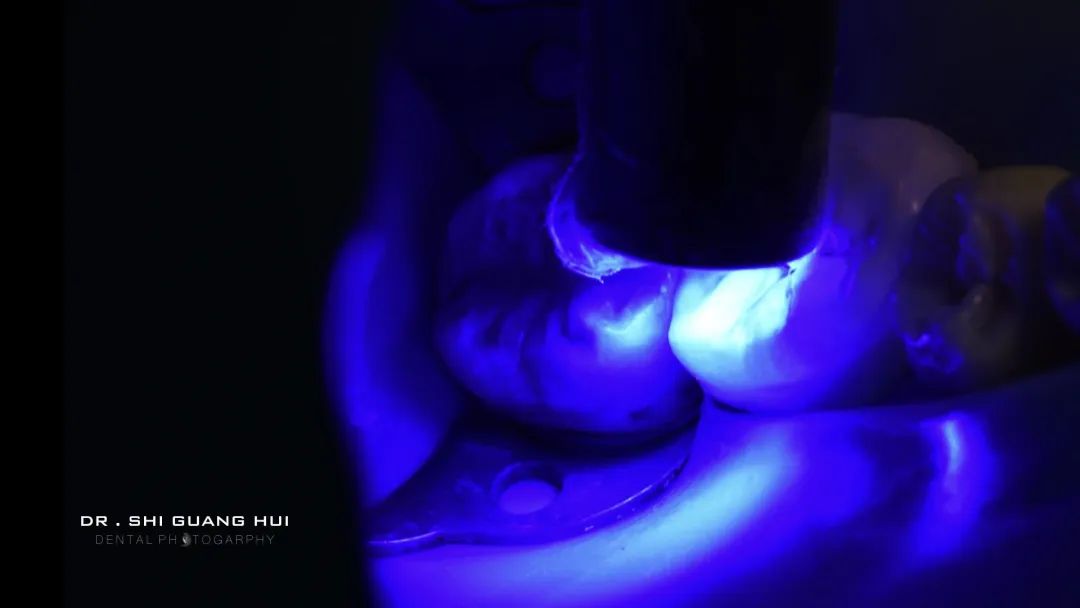 龈下缺损的新分类及治疗指南（前磨牙RCT龈壁提升后全覆盖嵌体修复一例）