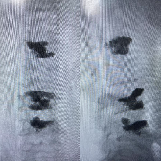 做完骨水泥手术，邻近椎体为啥