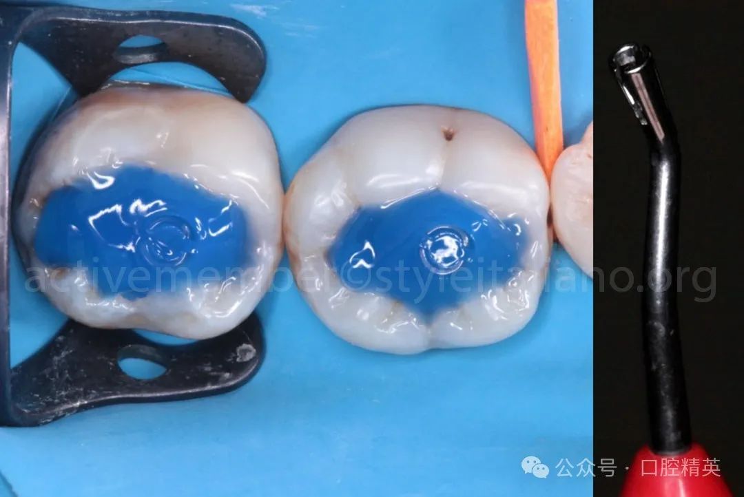 《印章法》后牙树脂充填