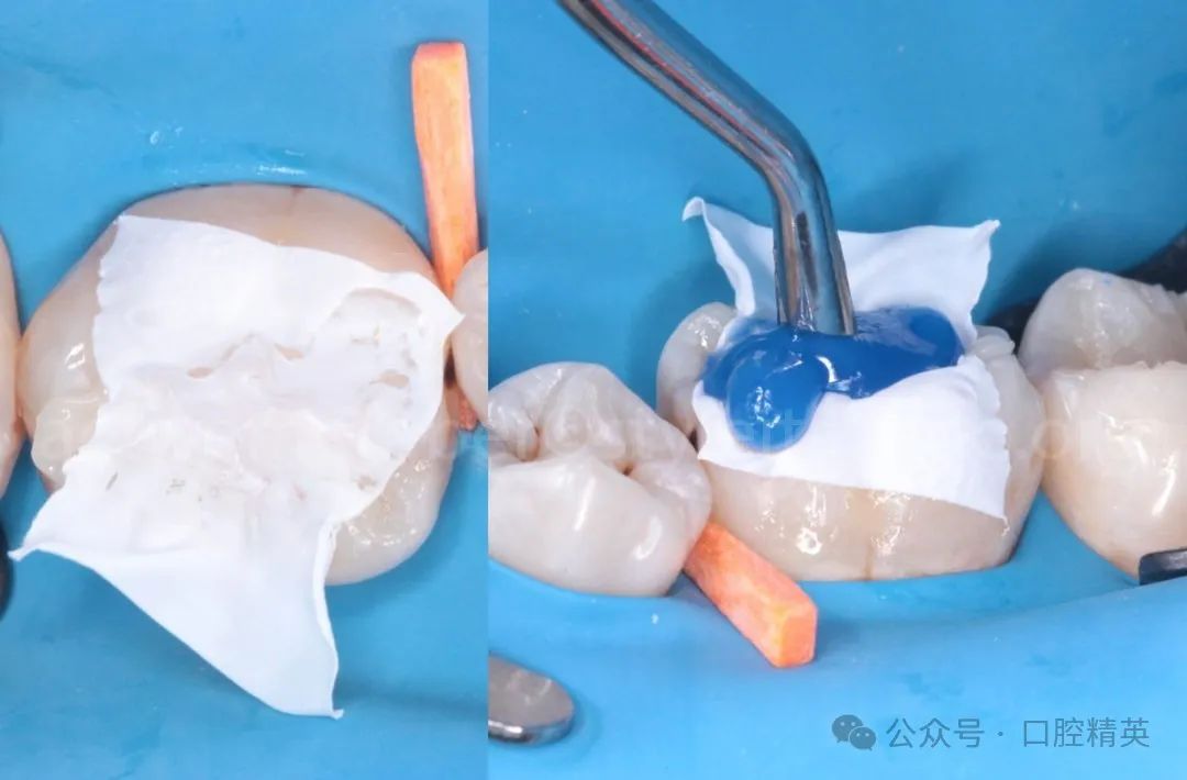 《印章法》后牙树脂充填