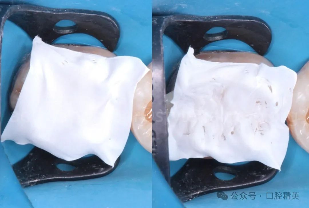 《印章法》后牙树脂充填