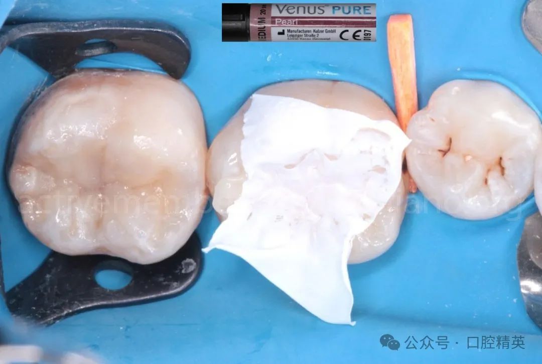 《印章法》后牙树脂充填