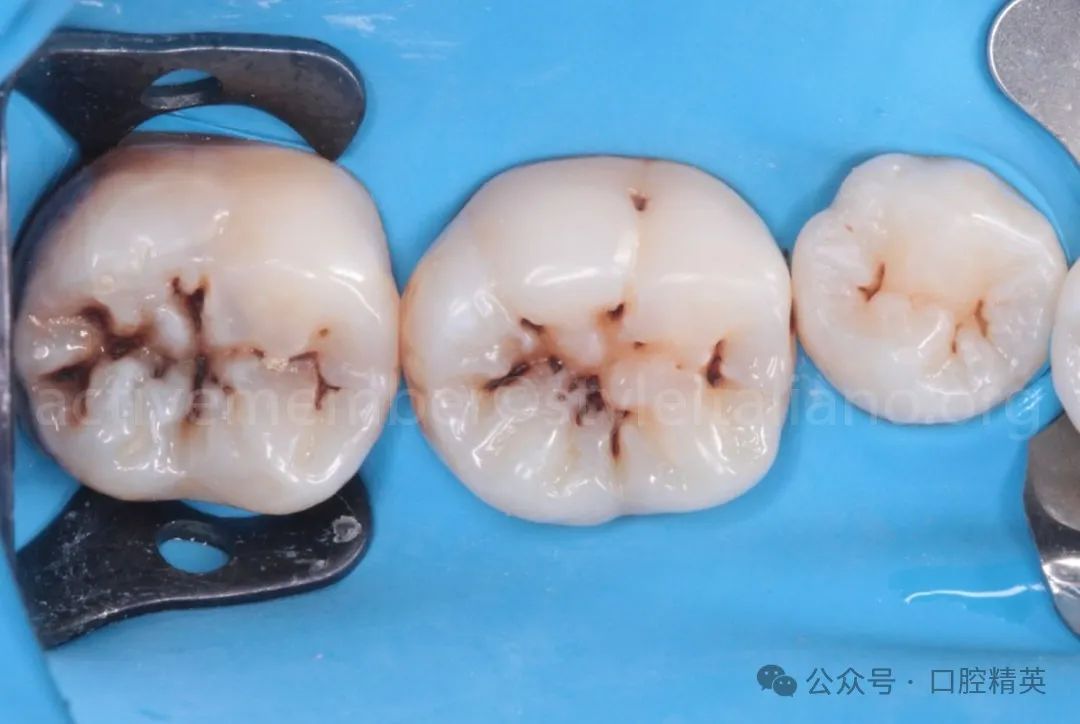 《印章法》后牙树脂充填