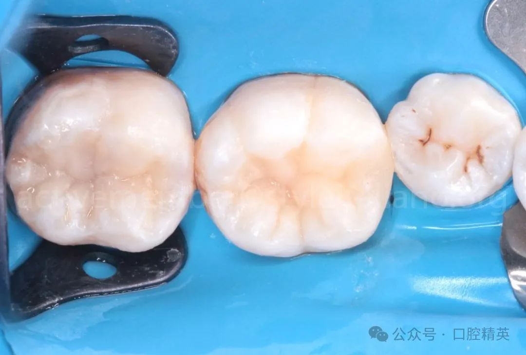 《印章法》后牙树脂充填