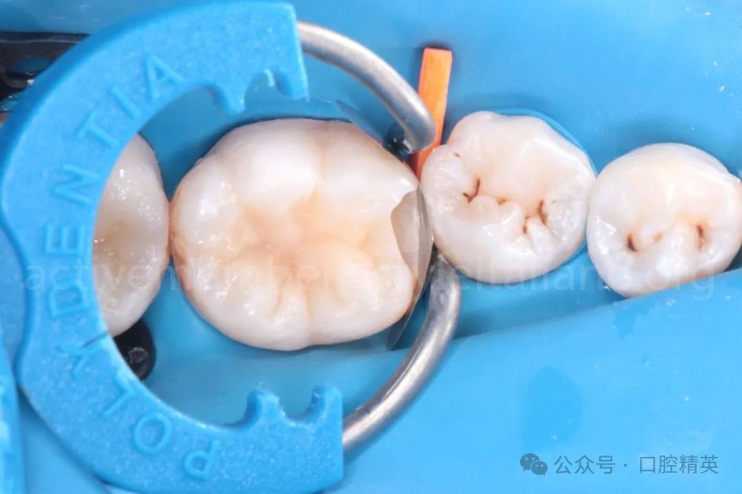 《印章法》后牙树脂充填