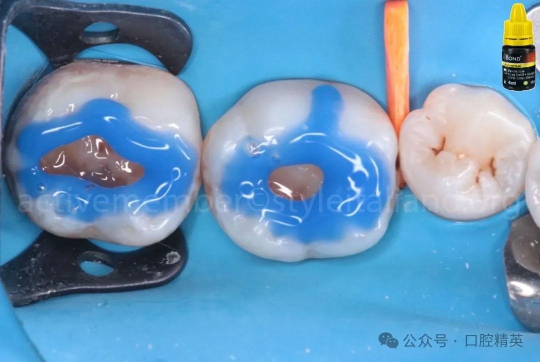 《印章法》后牙树脂充填