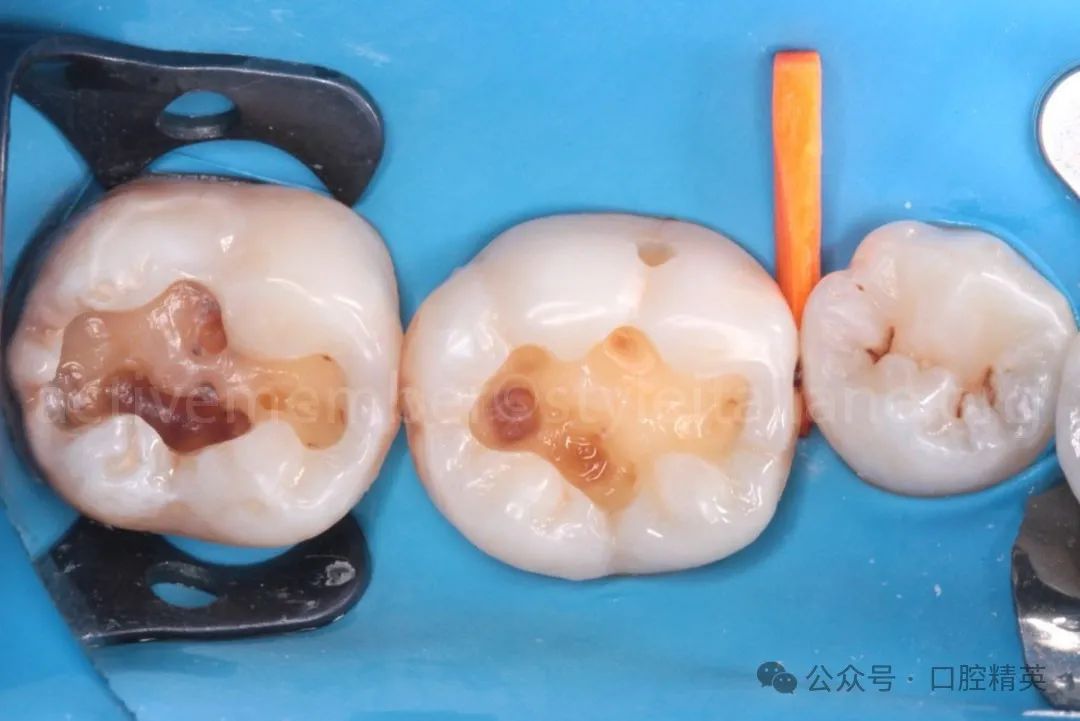 《印章法》后牙树脂充填