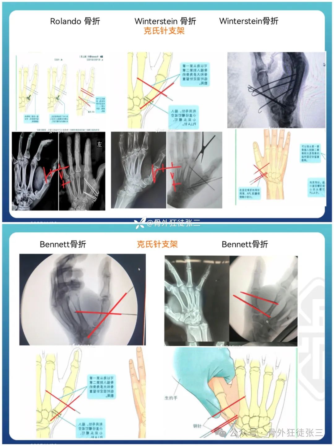 “针”人“针”事----万能克氏针在创骨科的应用