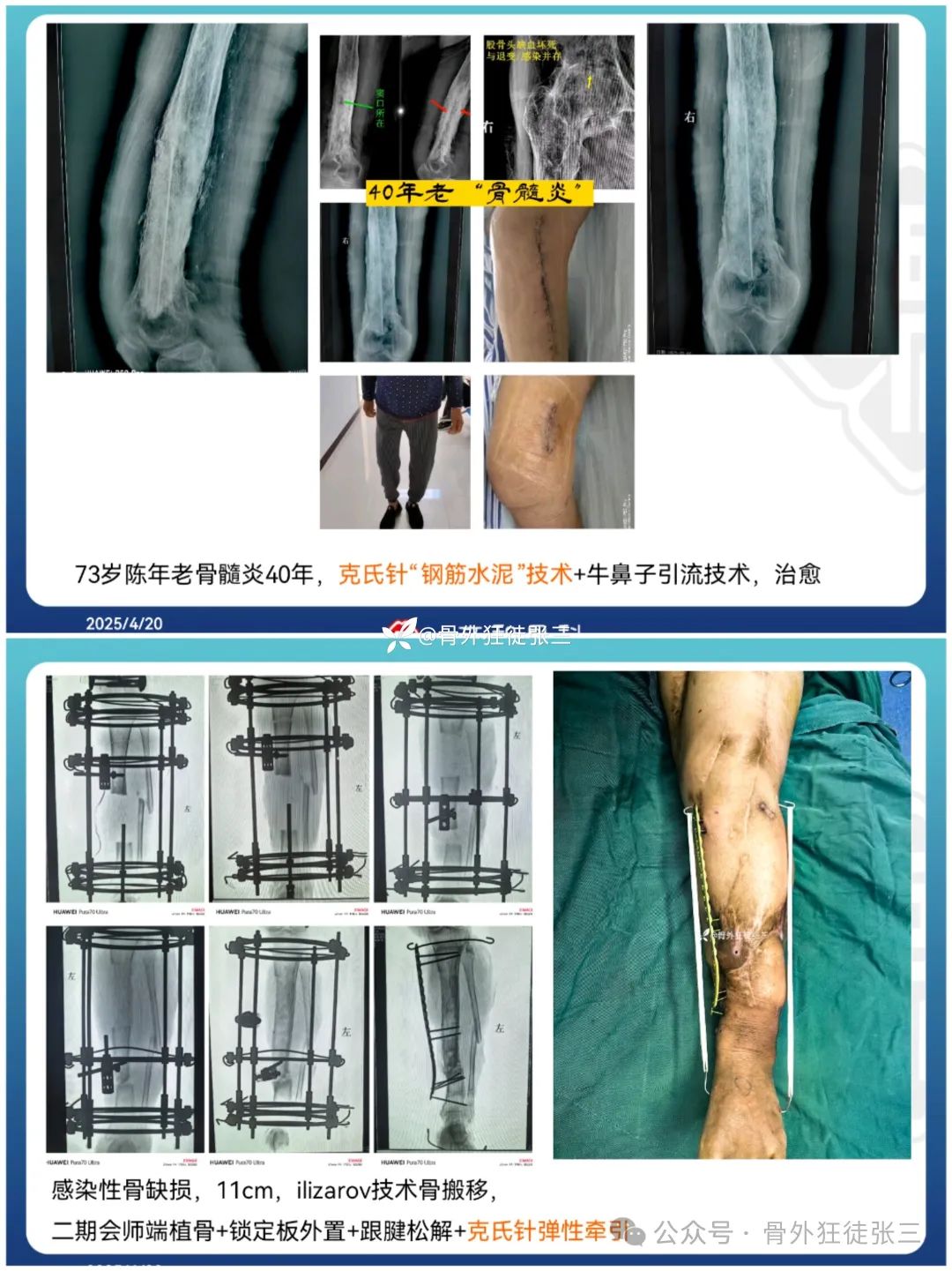 “针”人“针”事----万能克氏针在创骨科的应用