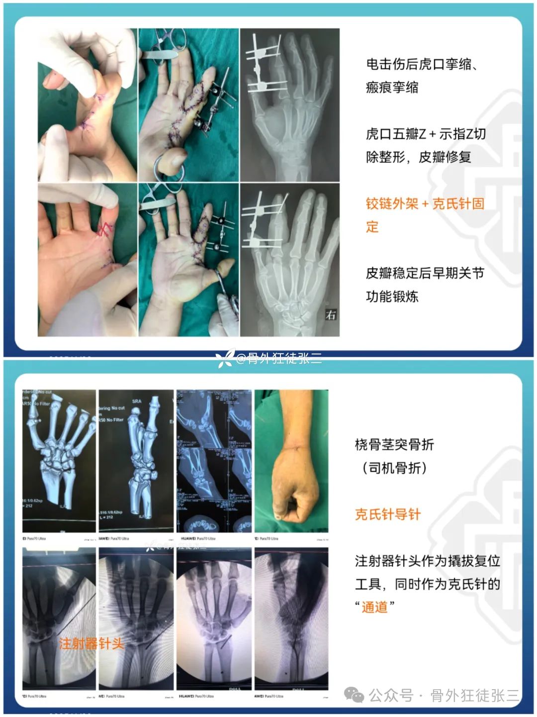 “针”人“针”事----万能克氏针在创骨科的应用