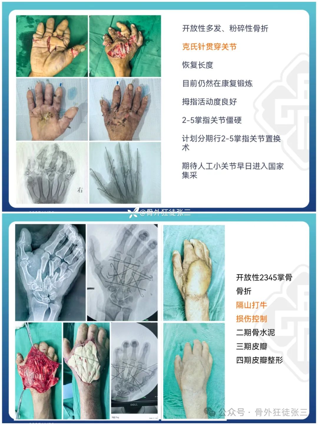 “针”人“针”事----万能克氏针在创骨科的应用