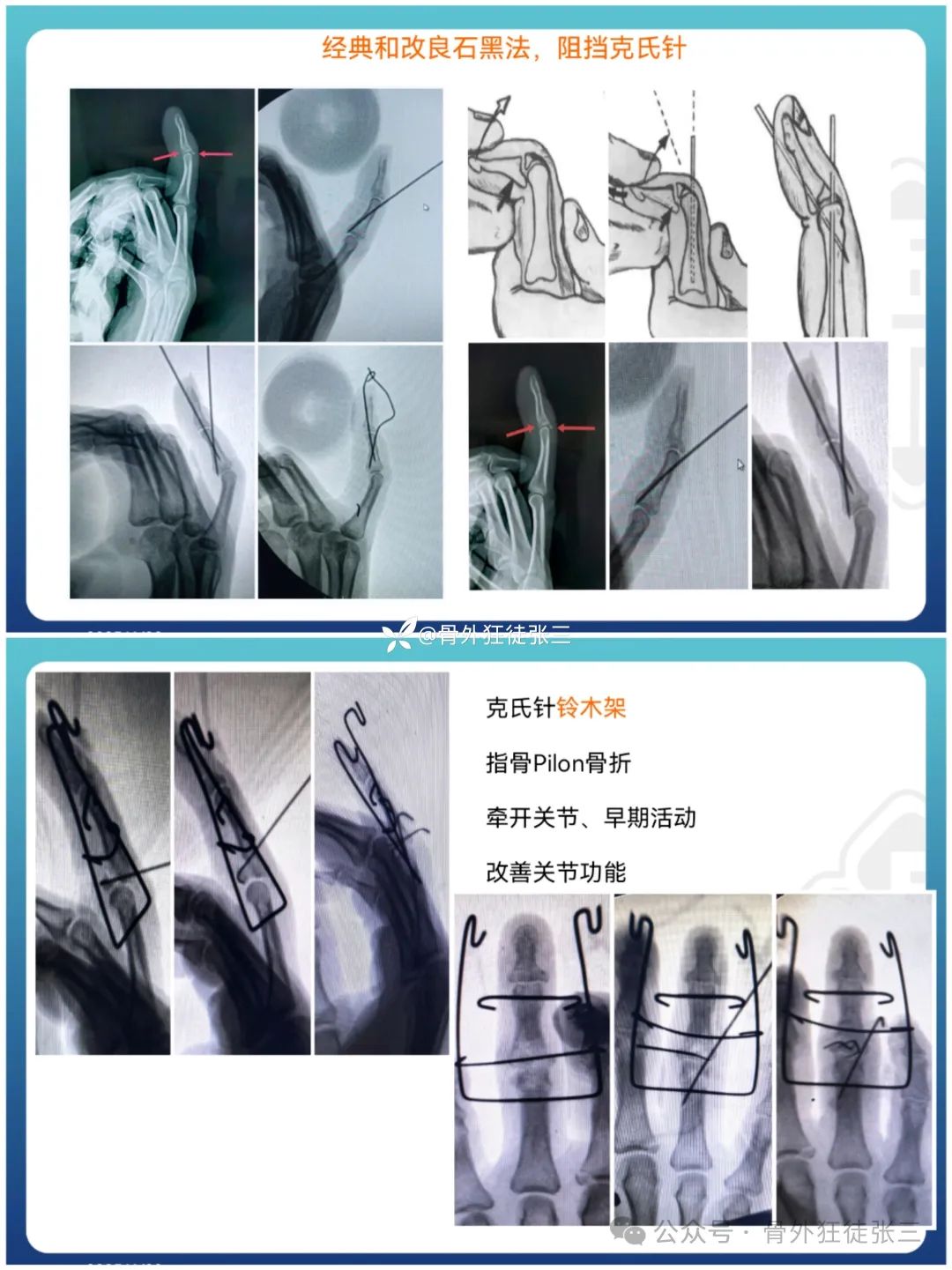 “针”人“针”事----万能克氏针在创骨科的应用