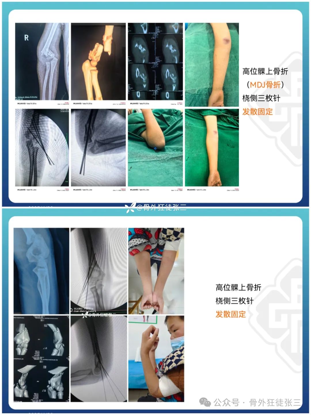“针”人“针”事----万能克氏针在创骨科的应用
