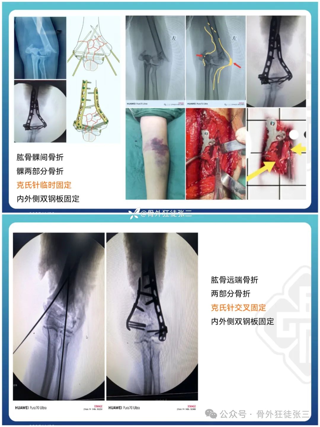 “针”人“针”事----万能克氏针在创骨科的应用