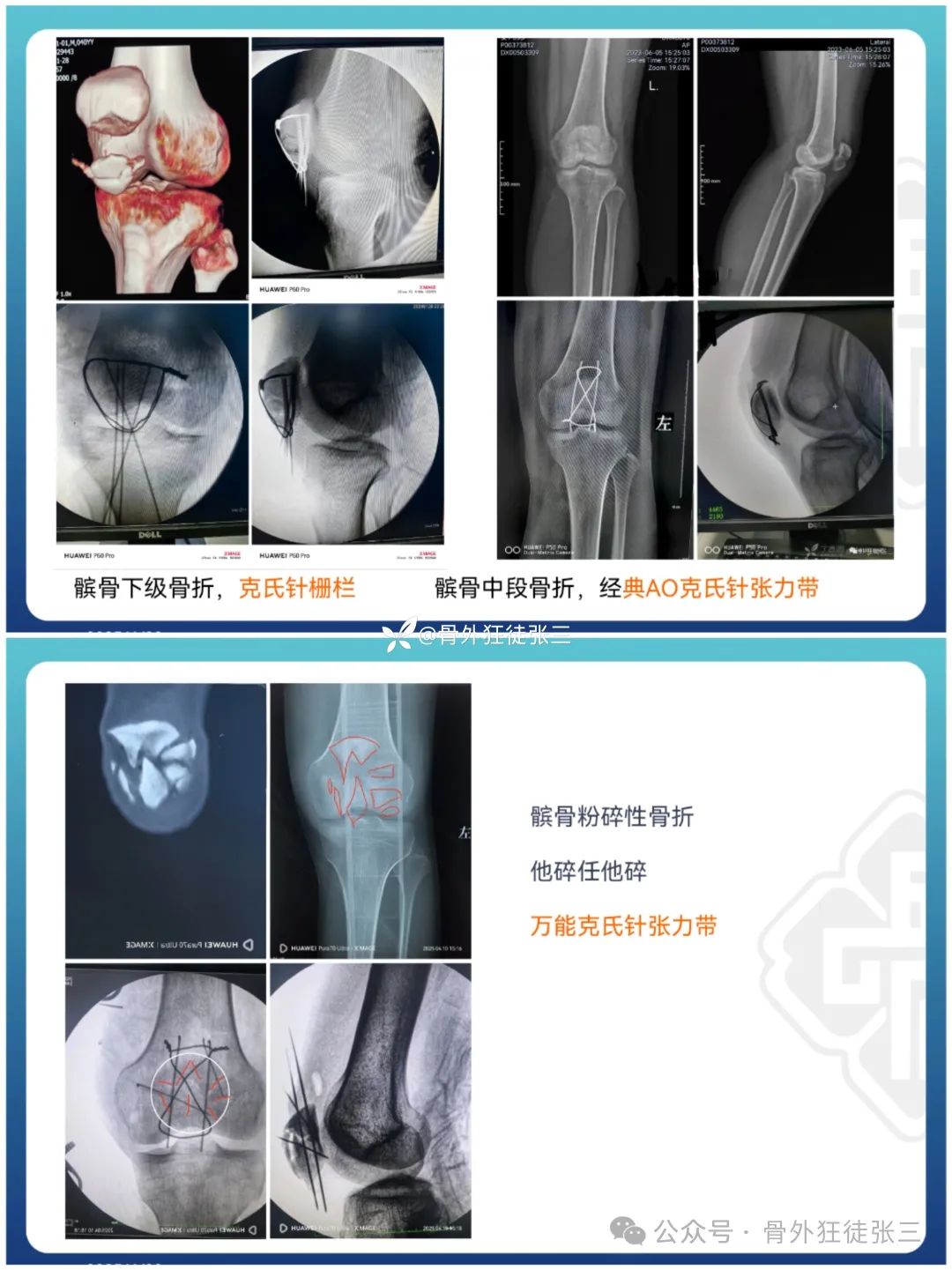 “针”人“针”事----万能克氏针在创骨科的应用