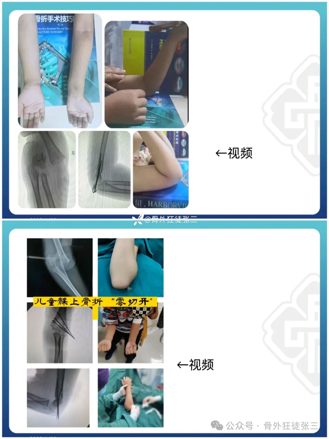 “针”人“针”事----万能克氏针在创骨科的应用