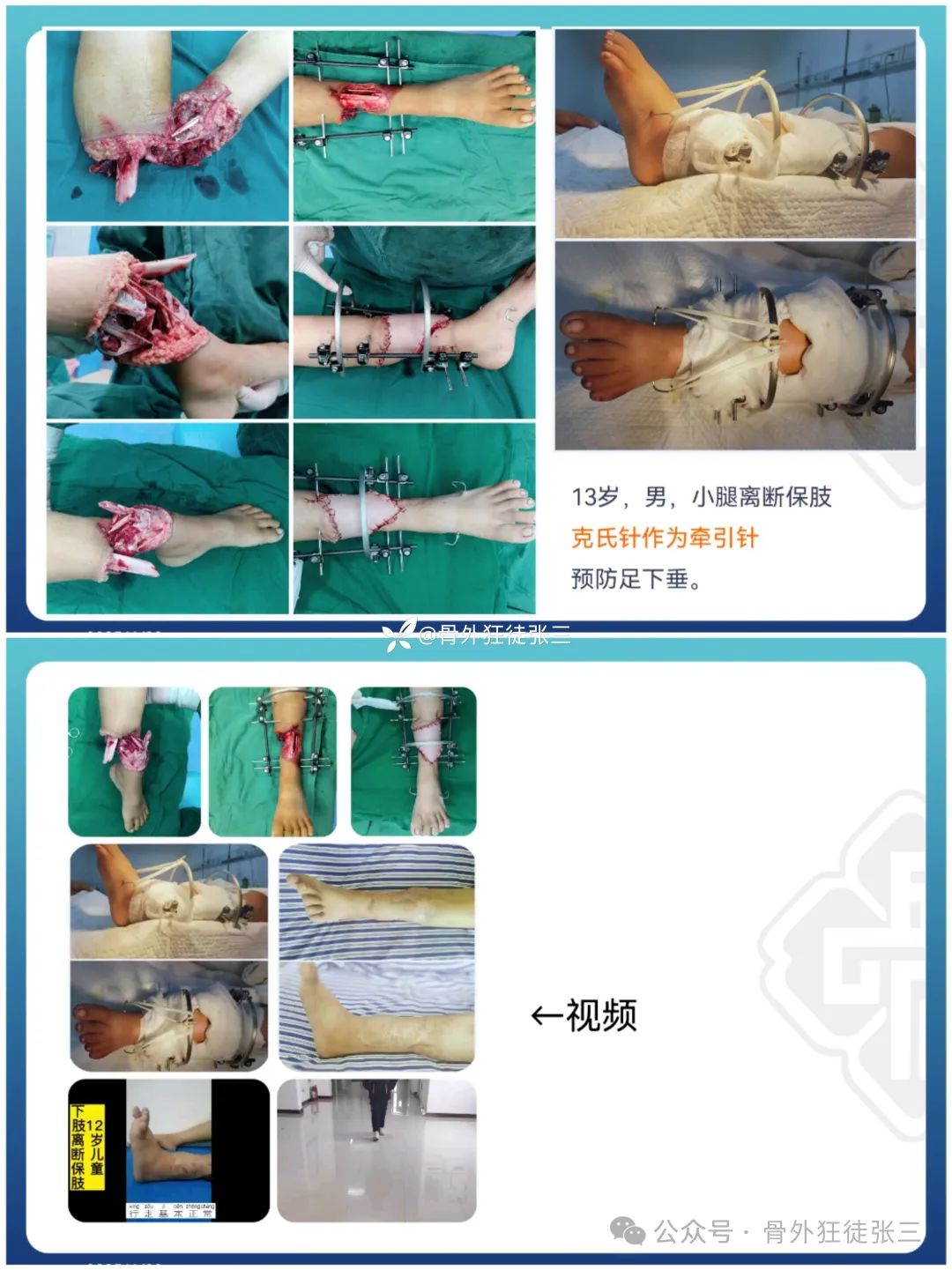 “针”人“针”事----万能克氏针在创骨科的应用